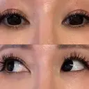 下まぶたの脂肪取り Brandnew Beauty Clinic AFTER サムネイル用