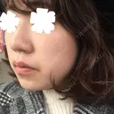 鼻尖形成（切開） / 小鼻縮小（切開） / その他（鼻） / 軟骨移植 JUN CLINIC DAY 54 サムネイル用