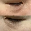 ニードルRF（ポテンツァなど） 表参道スキンクリニック 名古屋院（DAILY SKIN CLINIC提携院） DAY 5 サムネイル用