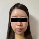 糸リフト / 脂肪吸引（顔） / ヒアルロン酸注入（あご） / ヒアルロン酸注入（こめかみ） BLINC CLINIC （ブリンク クリニック） DAY 5 サムネイル用