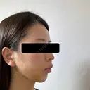 糸リフト / 脂肪吸引（顔） / ヒアルロン酸注入（あご） / ヒアルロン酸注入（こめかみ） BLINC CLINIC （ブリンク クリニック） DAY 5 サムネイル用