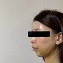 糸リフト / 脂肪吸引（顔） / ヒアルロン酸注入（あご） / ヒアルロン酸注入（こめかみ） BLINC CLINIC （ブリンク クリニック） DAY 5 サムネイル用