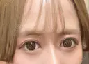 二重切開 高須クリニック 名古屋院 AFTER サムネイル用