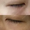 ニードルRF（ポテンツァなど） 表参道スキンクリニック 名古屋院（DAILY SKIN CLINIC提携院） DAY 6 サムネイル用