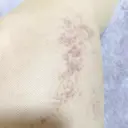 脂肪吸引（脚） / 豊胸（脂肪注入） S.T styleクリニック DAY 14 サムネイル用