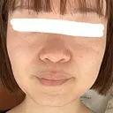ボトックス（エラ・小顔） 湘南美容クリニック 金山院 AFTER サムネイル用