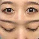 下まぶたの脂肪取り Brandnew Beauty Clinic DAY 22 サムネイル用