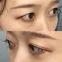 下まぶたの脂肪取り Brandnew Beauty Clinic DAY 22 サムネイル用