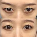 下まぶたの脂肪取り Brandnew Beauty Clinic DAY 22 サムネイル用