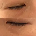 ニードルRF（ポテンツァなど） 表参道スキンクリニック 名古屋院（DAILY SKIN CLINIC提携院） DAY 7 サムネイル用