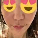 糸リフト / 脂肪吸引（顔） / ボトックス（エラ・小顔） / ヒアルロン酸注入（頬） Tokyo Tensei Clinic 新宿院 DAY 36 サムネイル用