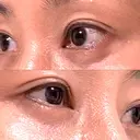 目尻切開 / タレ目形成・グラマラスライン（埋没） / 美容点滴・美容注射（美肌） LOUIS CLINIC 二子玉川院【ルイクリニック】 DAY 31 サムネイル用
