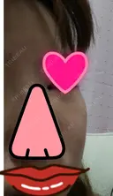 切開リフト こうべ花時計クリニック DAY 16 サムネイル用