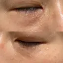 ニードルRF（ポテンツァなど） 表参道スキンクリニック 名古屋院（DAILY SKIN CLINIC提携院） DAY 9 サムネイル用