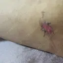 脂肪吸引（脚） / 豊胸（脂肪注入） S.T styleクリニック DAY 18 サムネイル用