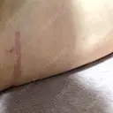 脂肪吸引（脚） / 豊胸（脂肪注入） S.T styleクリニック DAY 18 サムネイル用