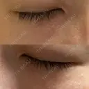 ニードルRF（ポテンツァなど） 表参道スキンクリニック 名古屋院（DAILY SKIN CLINIC提携院） AFTER サムネイル用