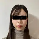 糸リフト / 脂肪吸引（顔） / ヒアルロン酸注入（あご） / ヒアルロン酸注入（こめかみ） BLINC CLINIC （ブリンク クリニック） DAY 11 サムネイル用