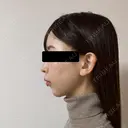 糸リフト / 脂肪吸引（顔） / ヒアルロン酸注入（あご） / ヒアルロン酸注入（こめかみ） BLINC CLINIC （ブリンク クリニック） DAY 11 サムネイル用