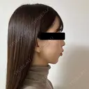 糸リフト / 脂肪吸引（顔） / ヒアルロン酸注入（あご） / ヒアルロン酸注入（こめかみ） BLINC CLINIC （ブリンク クリニック） DAY 11 サムネイル用