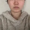 バッカルファット除去 / 脂肪吸引（顔） 湘南美容クリニック 京都院 DAY 142 サムネイル用