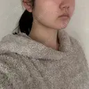 バッカルファット除去 / 脂肪吸引（顔） 湘南美容クリニック 京都院 DAY 142 サムネイル用