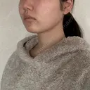 バッカルファット除去 / 脂肪吸引（顔） 湘南美容クリニック 京都院 DAY 142 サムネイル用