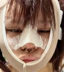 鼻尖形成（切開） / 糸リフト / 脂肪吸引（顔） / ジョールファット除去 / ヒアルロン酸注入（あご） / ヒアルロン酸注入（唇） / ボトックス（口角） / ヒアルロン酸注入（額） / ヒアルロン酸注入（鼻翼基部） 東京シンデレラ美容外科 池袋院 DAY 0 サムネイル用