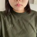 ボトックス（エラ・小顔） TCB東京中央美容外科 京都駅前院 DAY 8 サムネイル用