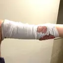 脂肪吸引（二の腕） アムルーズ美容外科クリニック 大阪院 DAY 0 サムネイル用