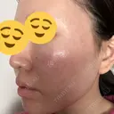 その他（肌） / 美肌レーザー 湘南美容クリニック 静岡院 DAY 0 サムネイル用