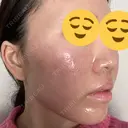 その他（肌） / 美肌レーザー 湘南美容クリニック 静岡院 DAY 0 サムネイル用