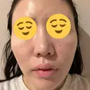 その他（肌） / 美肌レーザー 湘南美容クリニック 静岡院 DAY 3 サムネイル用