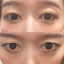 下まぶたの脂肪取り Brandnew Beauty Clinic AFTER サムネイル用