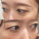 下まぶたの脂肪取り Brandnew Beauty Clinic DAY 30 サムネイル用