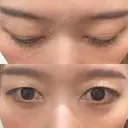 下まぶたの脂肪取り Brandnew Beauty Clinic DAY 30 サムネイル用