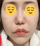 ボトックス（エラ・小顔） / ヒアルロン酸注入（頬） 高崎TAクリニック DAY 4 サムネイル用