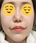 ボトックス（エラ・小顔） / ヒアルロン酸注入（頬） 高崎TAクリニック DAY 4 サムネイル用