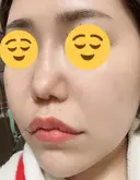 ボトックス（エラ・小顔） / ヒアルロン酸注入（頬） 高崎TAクリニック DAY 4 サムネイル用