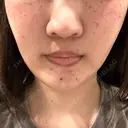 ルメッカ ルラ美容クリニック 大宮院 / ルラスキンクリニック 大宮院 DAY 0 サムネイル用