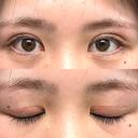 二重切開 つだ美容外科クリニック DAY 101 サムネイル用