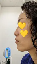 ヒアルロン酸注入（鼻） / 肌ヒアルロン酸注入（たるみ・シワ改善） / ボトックス（エラ・小顔） / シワ取りボトックス 東京形成美容外科 船橋院 DAY 0 サムネイル用