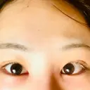 クマ治療 / ボトックス（エラ・小顔） / ヒアルロン酸注入（頬） TCB東京中央美容外科 京都駅前院 AFTER サムネイル用