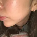 肌ヒアルロン酸注入（たるみ・シワ改善） BAO CLINIC 心斎橋院 DAY 8 サムネイル用