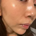 肌ヒアルロン酸注入（たるみ・シワ改善） BAO CLINIC 心斎橋院 DAY 11 サムネイル用