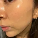 肌ヒアルロン酸注入（たるみ・シワ改善） BAO CLINIC 心斎橋院 DAY 11 サムネイル用
