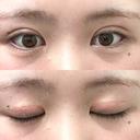 二重切開 つだ美容外科クリニック DAY 102 サムネイル用