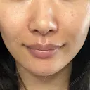 ヒアルロン酸注入（あご） / ヒアルロン酸注入（鼻翼基部） HAAB×DREAM BEAUTY CLINIC 東京本院 DAY 1 サムネイル用