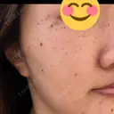 ルメッカ ルラ美容クリニック 大宮院 / ルラスキンクリニック 大宮院 DAY 1 サムネイル用