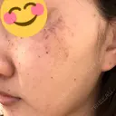 ルメッカ ルラ美容クリニック 大宮院 / ルラスキンクリニック 大宮院 DAY 1 サムネイル用